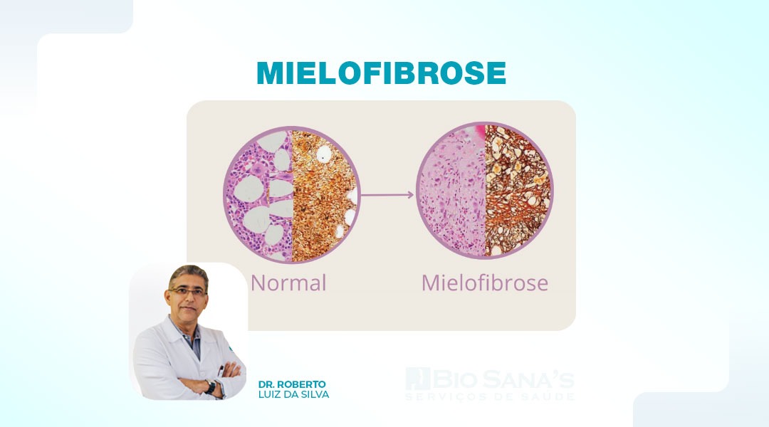 Mielofibrose