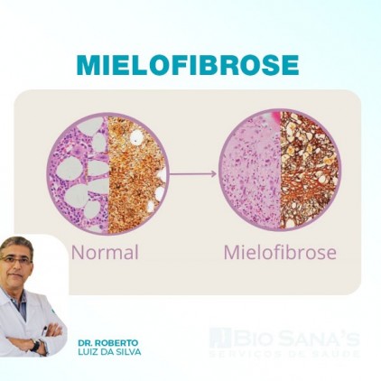 Mielofibrose