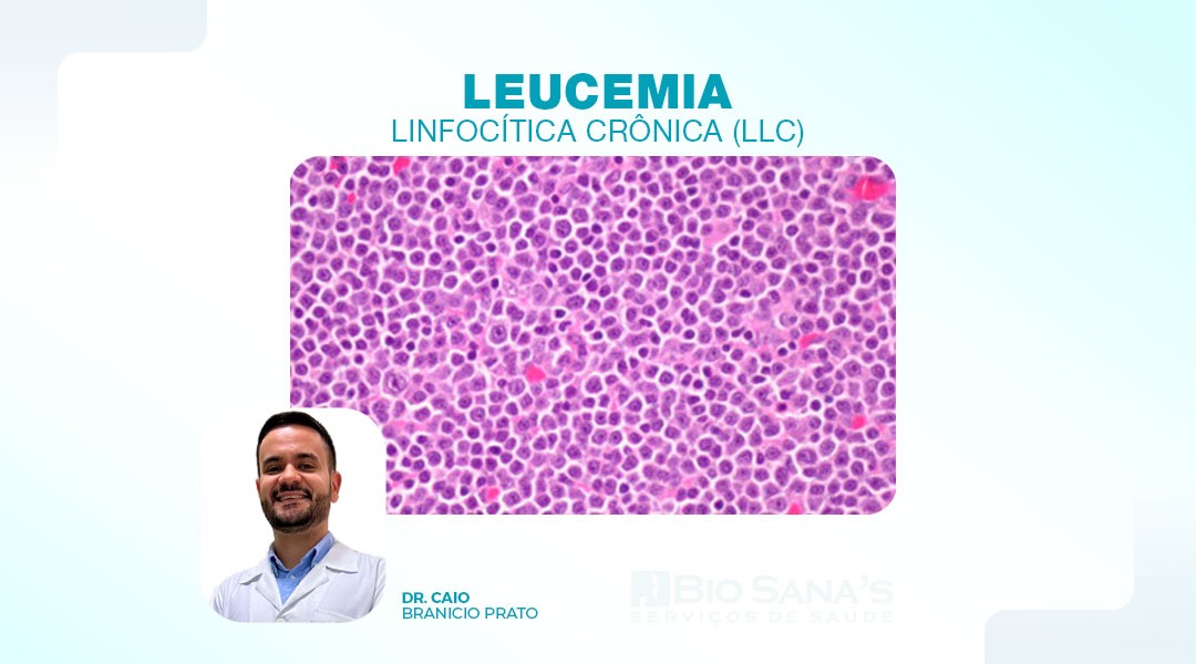 Leucemia Linfocítica Crônica