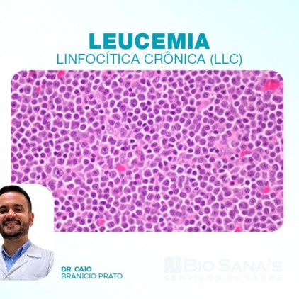 Leucemia Linfocítica Crônica