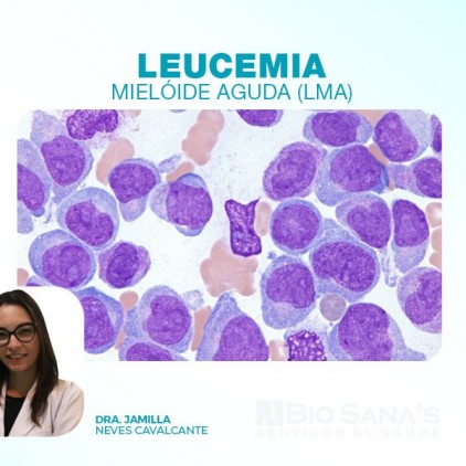 Leucemia Mielóide Aguda (LMA)