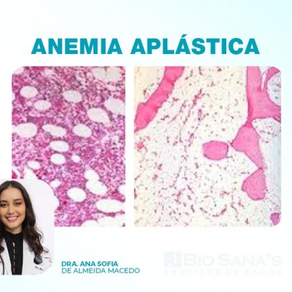 Anemia aplástica (AA) 