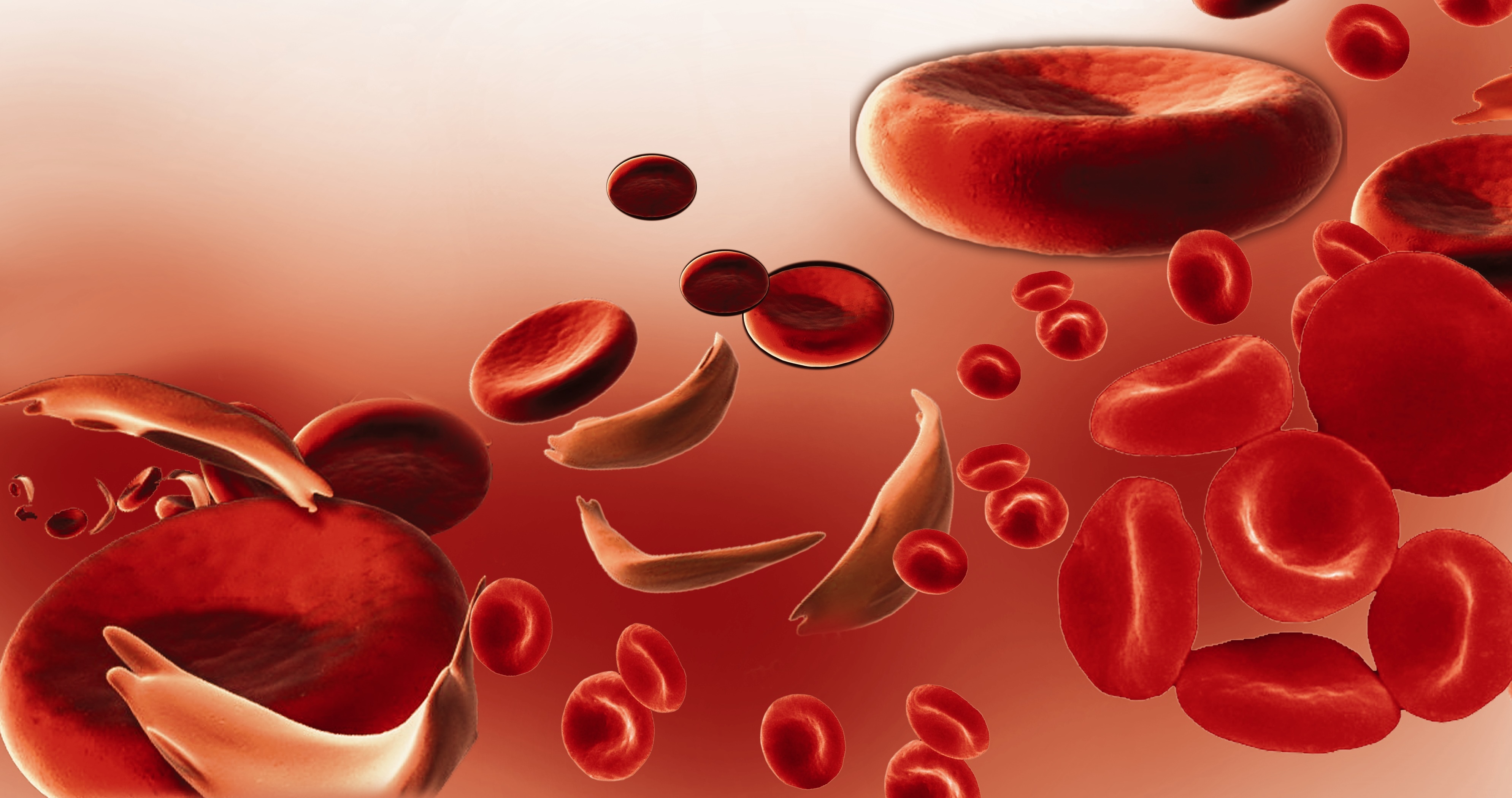 Anemia Falciforme