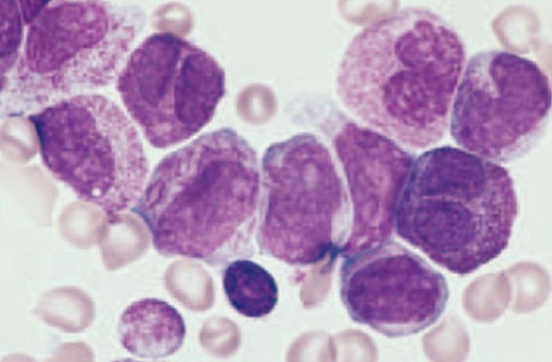 Leucemia Mielóide Aguda (LMA)