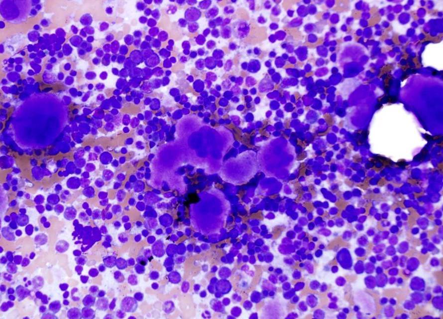 Púrpura Trombocitopênica Idiopática (PTI)