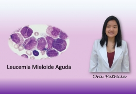 Leucemia Mieloide Aguda (LMA) por Dra. Patricia Miki Yamamoto, médica hematologista da equipe de hematologia e transplante de medula óssea da BIO SANA'S e do Hospital Leforte da Rede DASA