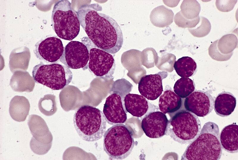 Leucemia Linfóide Aguda
