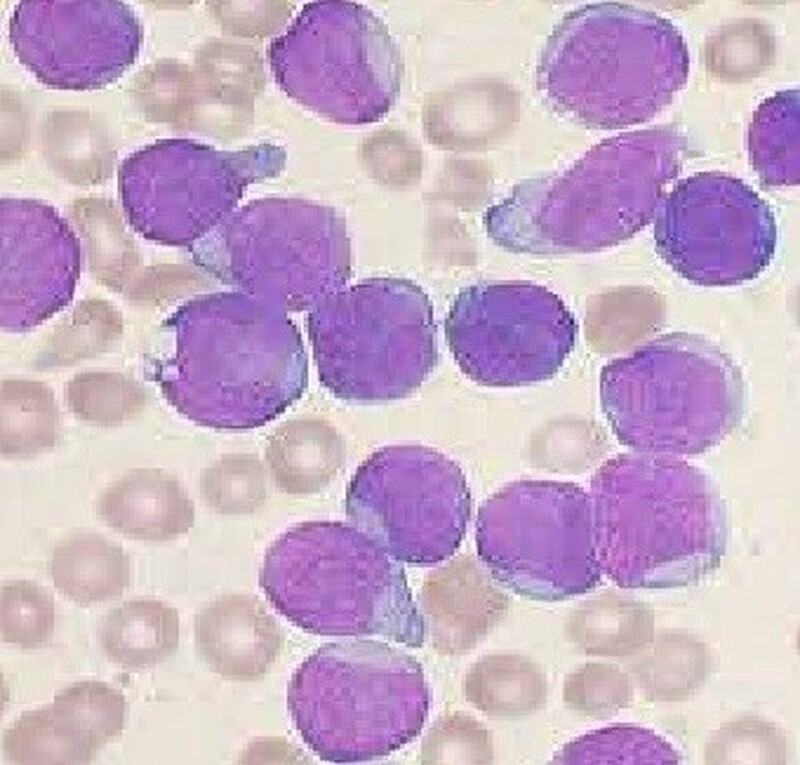 Leucemia Linfóide Crônica