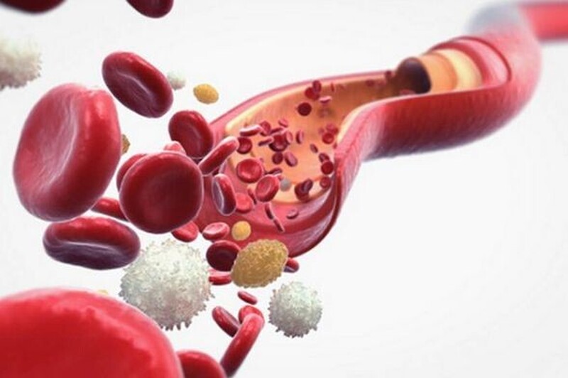 Aplasia de Medula Óssea ou Anemia Aplástica Grave