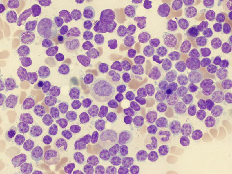Leucemia Mielóide Crônica